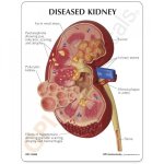 img_k62-normal-diseased-kidney-model-key-card.jpg