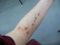 abscess_firstheroin-users-arm.jpg