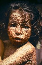 300px-Child_with_Smallpox_Bangladesh.jpg