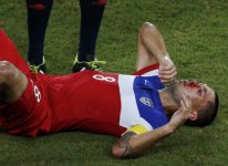 clint-dempsey-nasal-fracture.jpg