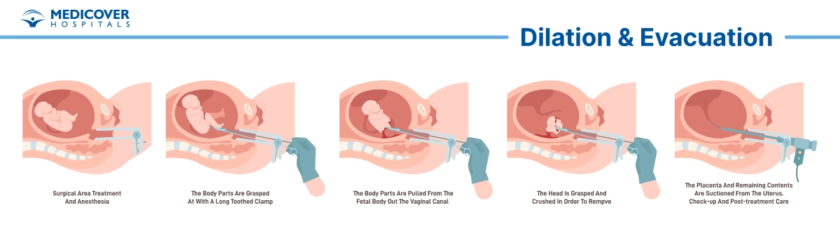 dilation-and-evacuation.webp